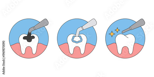 Illustration of dental filling procedure steps on tooth