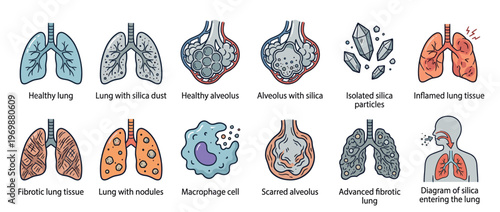 Medical illustration of silicosis showing healthy and diseased lungs, alveoli, and the progression of lung damage from silica dust inhalation.