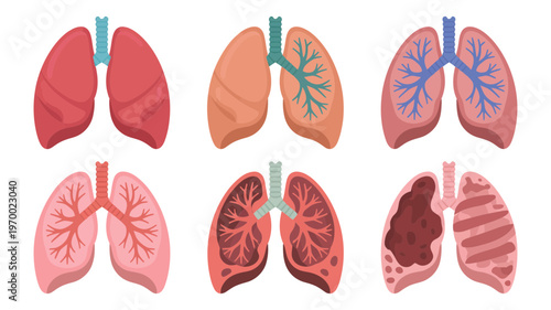 A detailed infographic showing healthy human lungs and various stages of lung diseases in a medical illustration set.