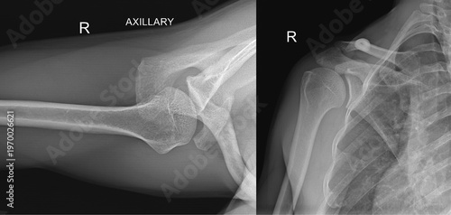 Fotografija Right Shoulder Joint X‑ray, AP and Axillary Views