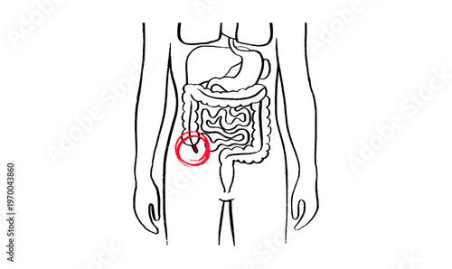 Inflamed appendix scetch