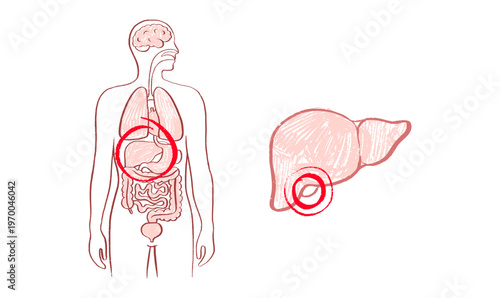 Human Gallbladder Disease