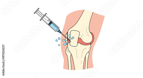 A human knee joint is shown in profile receiving an injection from a syringe with blue fluid splashing out.