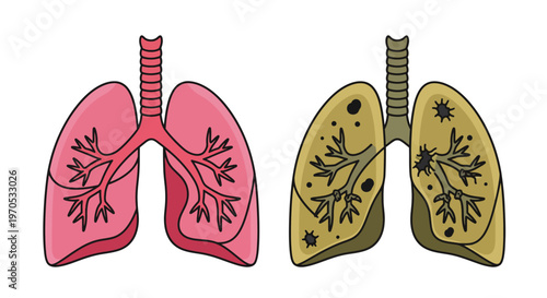 Healthy Pink Lungs Compared to Diseased Yellow Lungs Showing the Effects of Smoking