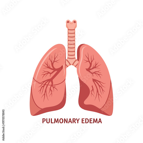 Pulmonary Edema: An illustrated depiction of lungs affected by pulmonary edema, highlighting the key features of the condition. 