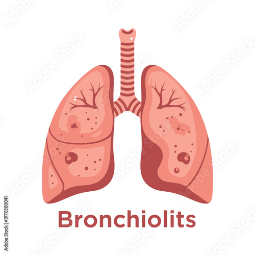 Bronchiolitis Illustration: A medical illustration depicts the intricate anatomy of the lungs, highlighting the condition of bronchiolitis