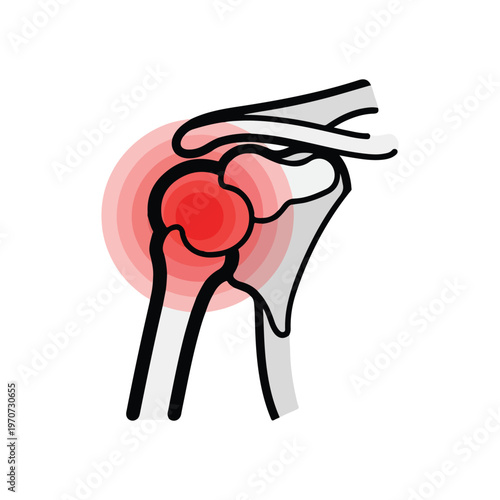 A medical illustration of a human hip joint with highlighted pain