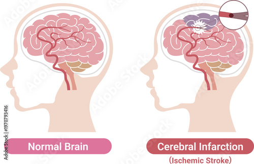 Ischemic stroke brain infarction comparison with normal brain medical illustration(English Labels)