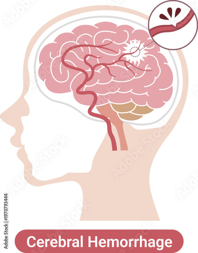Cerebral hemorrhage medical illustration brain bleeding diagram(English Labels)	