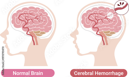 Cerebral hemorrhage comparison with normal brain medical illustration(English Labels)	
