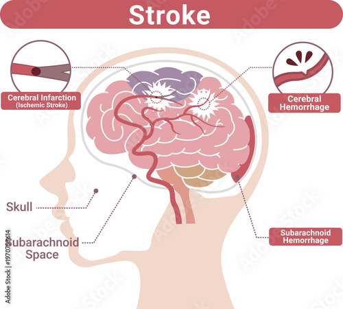 Stroke Types Medical Illustration(English Labels)	