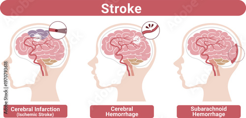 Stroke types brain infarction cerebral hemorrhage subarachnoid hemorrhage medical illustration(English Labels)