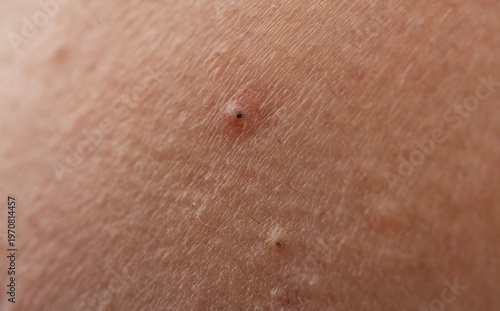 Pimple on pores with whiteheads and bumps. Acne with inflammation and papules. Skincare concept for acne and epidermis. Detail of pimple with blemish and irritation.