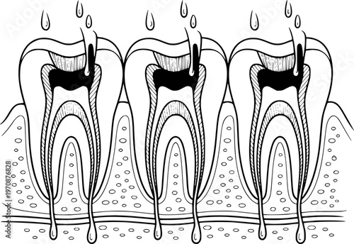 Detailed black and white of decaying teeth with visible internal structure and dripping fluid