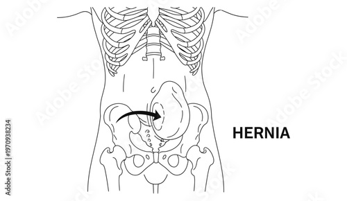 Human Abdominal Hernia Anatomical Vector Illustration