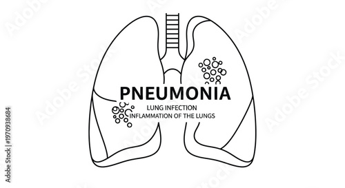 Pneumonia Lung Infection and Inflammation Medical Illustration