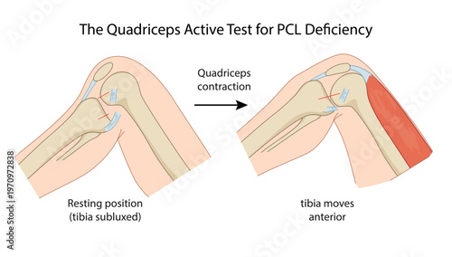 The Quadriceps Active Test for PCL Deficiency
where contraction of the quadriceps causes anterior translation of a posteriorly subluxed tibia, indicating a Posterior Crucial Ligament (PCL) injury.