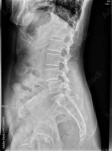 Tableau sur toile Lateral View of Lumbar Spine X-ray Showing Spondylolisthesis and Vertebral Slippage