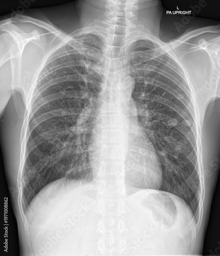 Medical Imaging Showing a  Pulmonary Nodule in Human Lung.