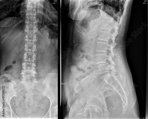 Fotografie Lumbar Spine X-ray Showing Spondylolisthesis and Vertebral Slippage