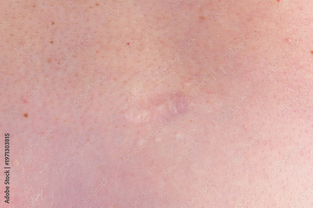 Fototapeta premium Close up of surgical scar after nevus removal on human skin showing healing and dermatology treatment