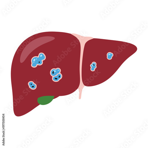 Illustration of a diseased human liver showing multiple metastatic tumors or cancer spots