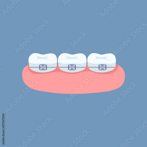 Icon of teeth with braces. Concept of orthodontic braces treatment on white teeth. Vector flat illustration of dentistry in a cartoon style.