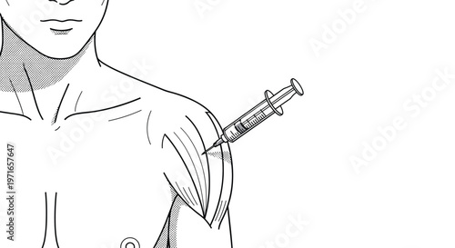 Medical illustration showing a syringe being used to deliver an injection into the muscle of a human shoulder or arm.
