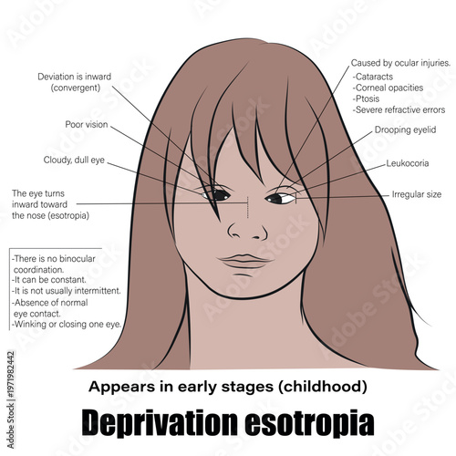 Deprivation esotropia (or sensory esotropia) is a convergent strabismus in which one eye turns inward due to severe vision loss, preventing the brain from fusing images.