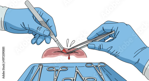 Vector illustration of surgeon's hands in blue gloves performing an incision using a scalpel and forceps on skin tissue.