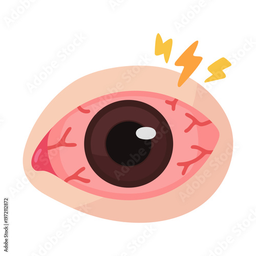 Inflamed Human Eyeball with Irritation and Redness, Showing Discomfort and Pain, Health Concern