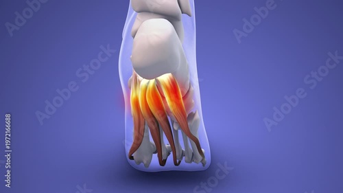 Plantar Fasciitis Causing Heel Pain and Inflammation