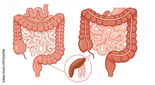 Illustration comparing a healthy human colon with an inflamed appendix and diverticula indicating disease