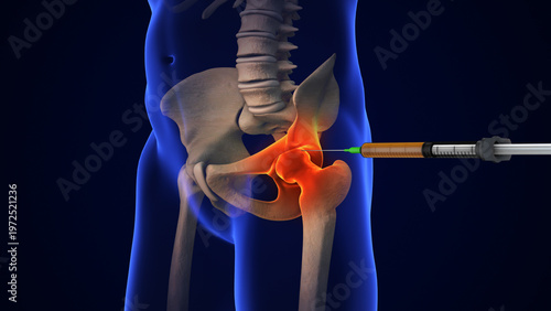 Human Hip Joint Pain Treatment Injection Concept