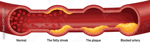 This illustration depicts a cross section of a human artery showcasing varying degrees of plaque buildup and obstruction high quality professional detailed modern