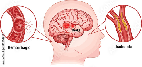 This illustration depicts the human brain and vasculature showcasing both hemorrhagic and ischemic stroke types and their effects high quality professional detailed modern
