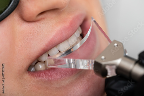 Gum correction surgery with laser