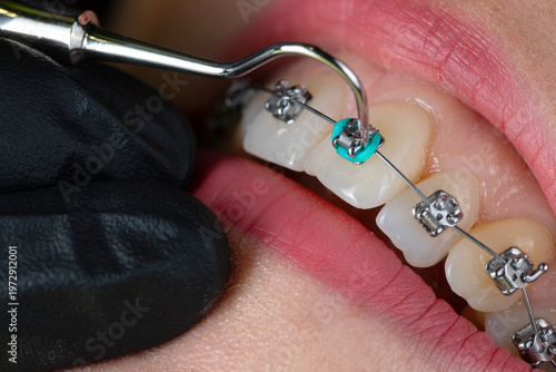 Dental braces examination, ororthodontic consultation
