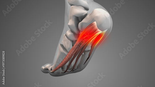 Plantar Fascia Strain Leading to Foot Pain