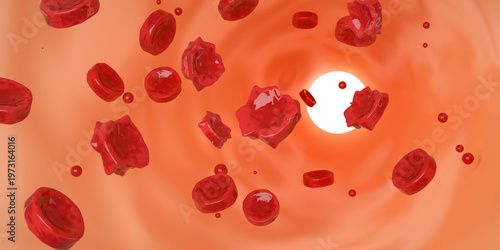 Foto Thalassemia