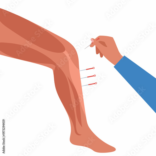 This image illustrates acupuncture treatment on a leg, showcasing needles inserted at various points to highlight the therapeutic approach in traditional medicine.