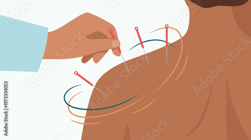 The image showcases an acupuncture treatment session, illustrating the insertion of needles into a person's back to promote healing and reduce pain through alternative medicine techniques.