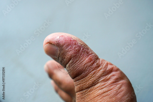 Photography closeup toe with painful blister and peeling skin showing irritated inflamed foo