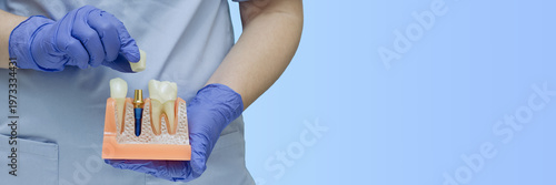 Fotografie Dental implant banner with copy space: Dentist hands holding jaw model with titanium screw and ceramic crown