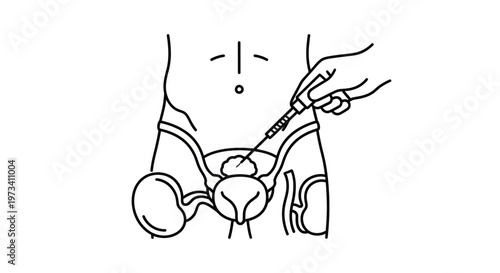 Medical illustration of a needle injecting into the bladder, urology concept