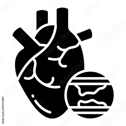 Atherosclerosis Illustration: Heart with Clogged Artery