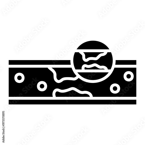 Atherosclerosis: Blocked Artery Illustration
