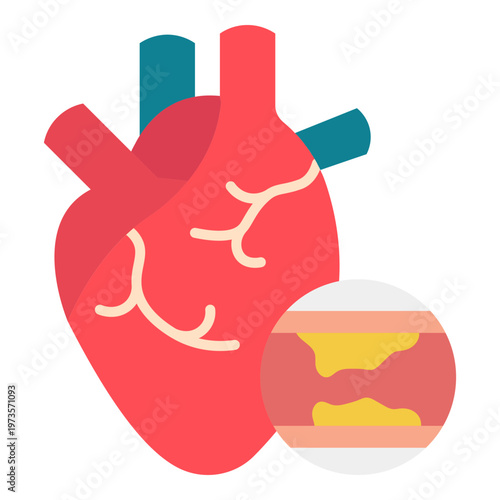 Heart with Artery Blockage Illustration