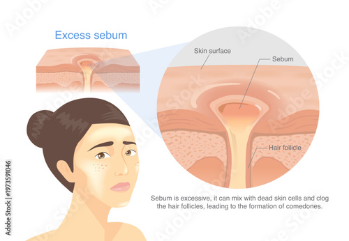 Excess sebum on the skin surface. Woman's face too much oil from the sebaceous gland mixes with dead skin cells and clogs the hair follicle, leading to clogged pores, comedones, blackheads, whiteheads