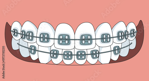 Dental Braces on Transparent Teeth Illustration